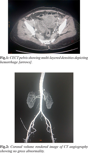 Endovascular Management Of A Rare Cause Of Pelvic Hemorrhage